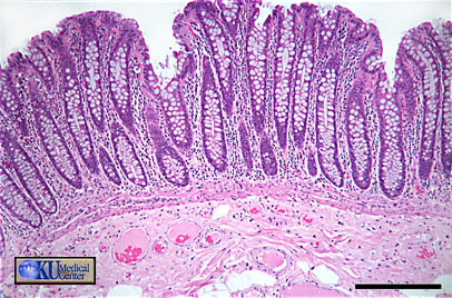 Colon (tyndtarm)